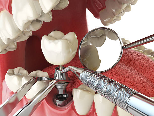 Best Emergency Wisdom Teeth Removal in Commerce, CA